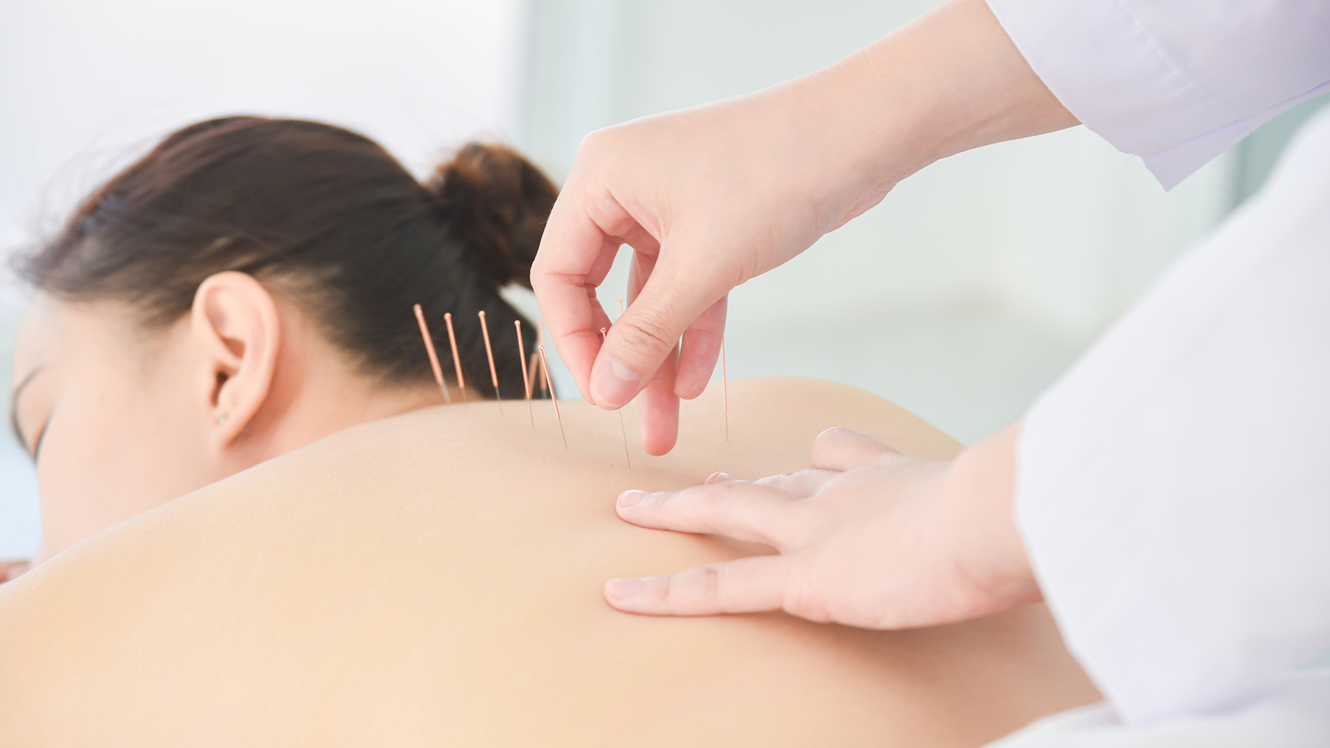 Hands of therapist doing acupuncture at patient back ,Alternativ